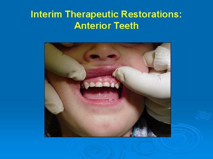 Interim Therapeutic Restorations: Anterior Teeth 