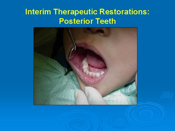 Interim Therapeutic Restorations: Posterior Teeth 