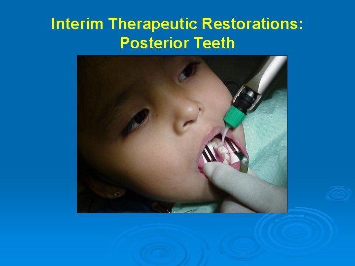 Interim Therapeutic Restorations: Posterior Teeth 