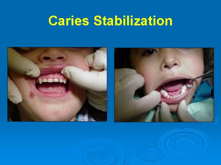 Caries Stabilization 