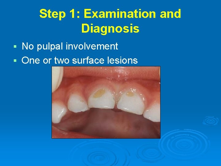 Step 1: Examination and Diagnosis No pulpal involvement § One or two surface lesions