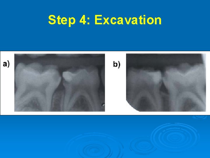 Step 4: Excavation 