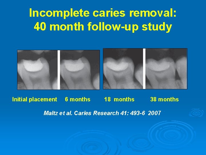 Incomplete caries removal: 40 month follow-up study Initial placement 6 months 18 months 38