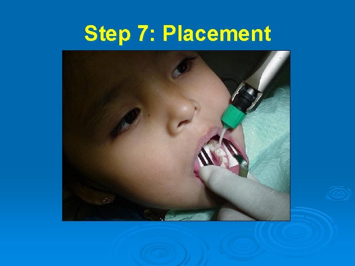 Step 7: Placement 