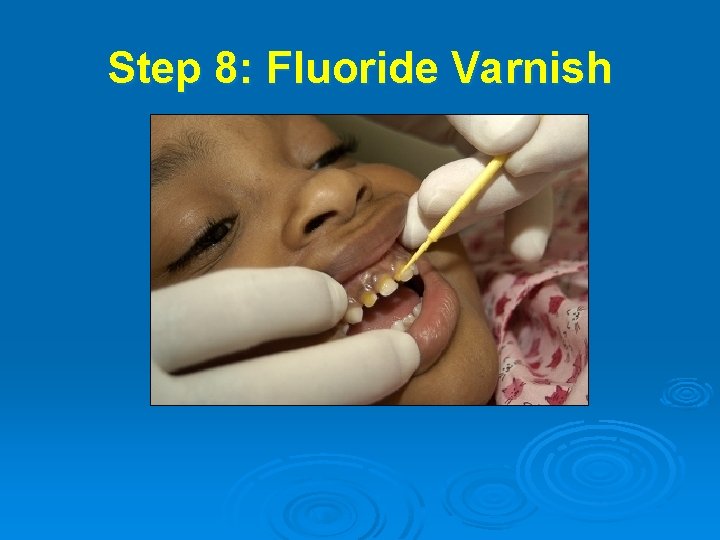 Step 8: Fluoride Varnish 