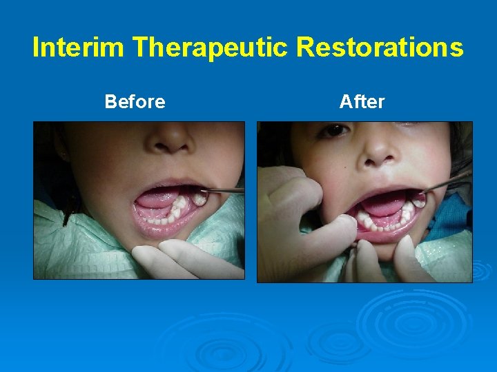 Interim Therapeutic Restorations Before After 