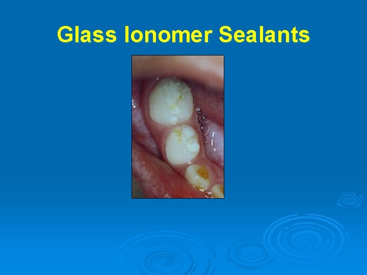 Glass Ionomer Sealants 