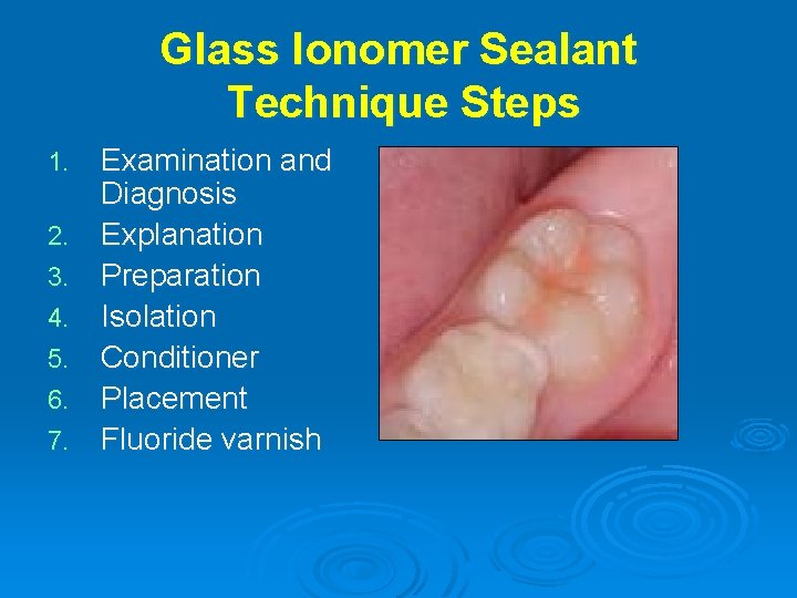 Glass Ionomer Sealant Technique Steps 1. 2. 3. 4. 5. 6. 7. Examination and