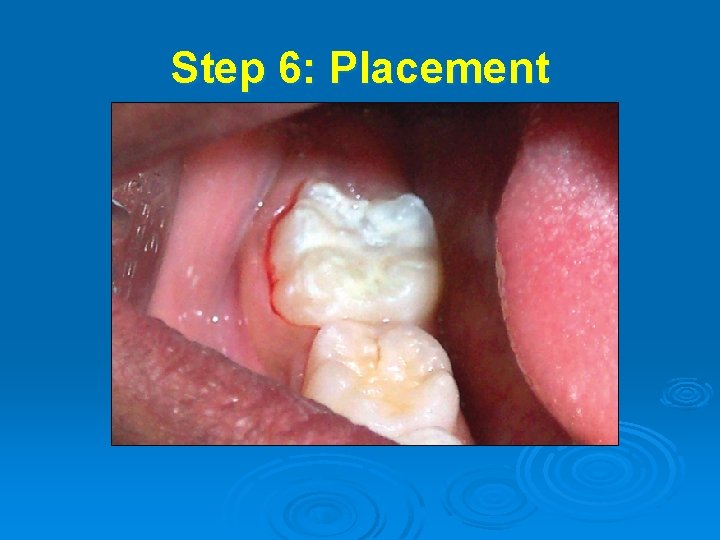 Step 6: Placement 