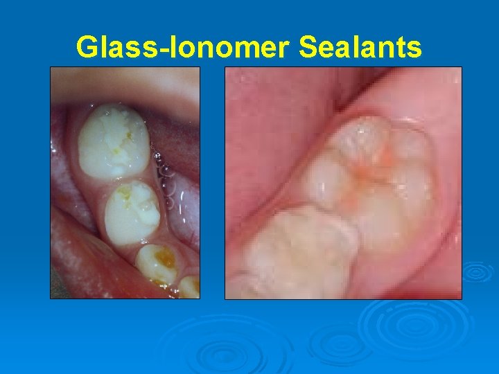 Glass-Ionomer Sealants 