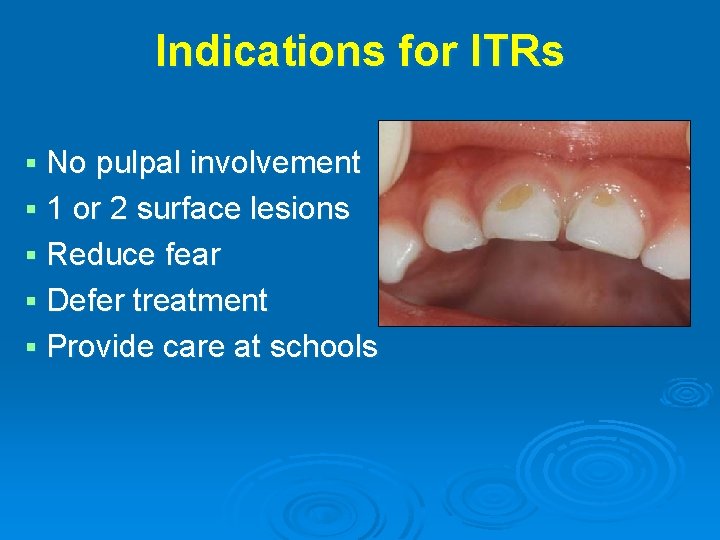 Indications for ITRs § No pulpal involvement § 1 or 2 surface lesions §