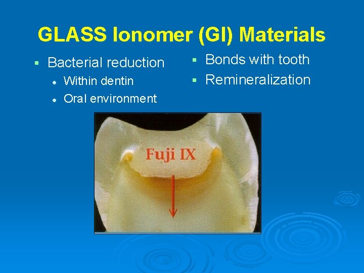 GLASS Ionomer (GI) Materials § Bacterial reduction l l Within dentin Oral environment Bonds