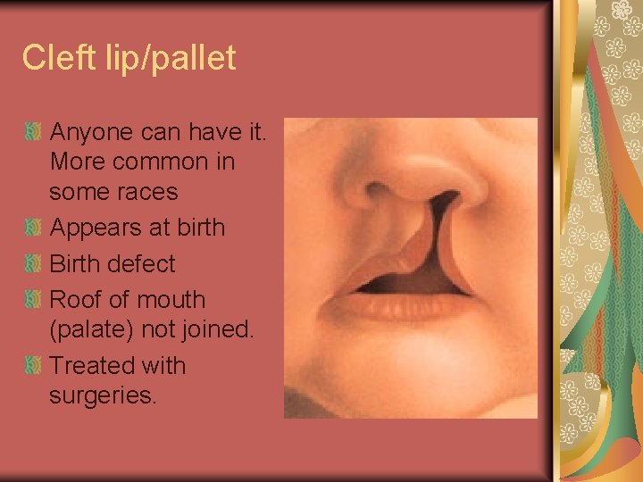 Cleft lip/pallet Anyone can have it. More common in some races Appears at birth