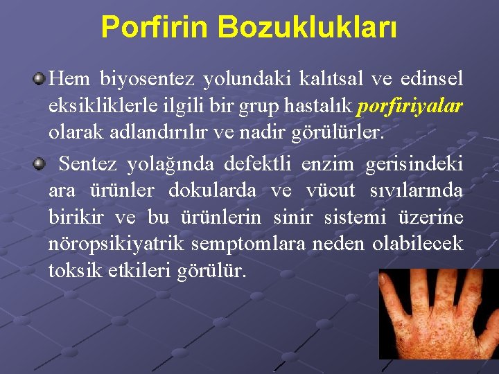 Porfirin Bozuklukları Hem biyosentez yolundaki kalıtsal ve edinsel eksikliklerle ilgili bir grup hastalık porfiriyalar