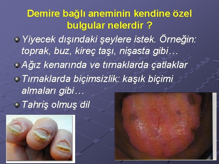 Demire bağlı aneminin kendine özel bulgular nelerdir ? Yiyecek dışındaki şeylere istek. Örneğin: toprak,