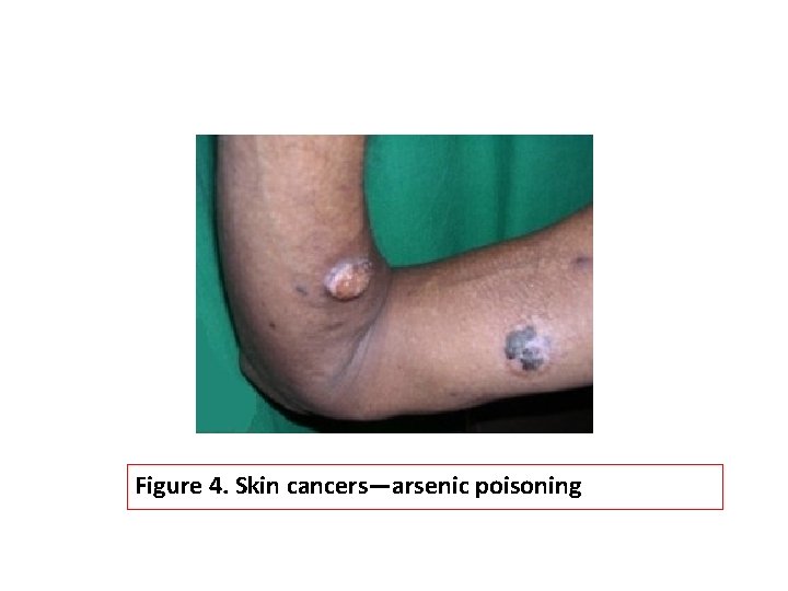 Figure 4. Skin cancers—arsenic poisoning 