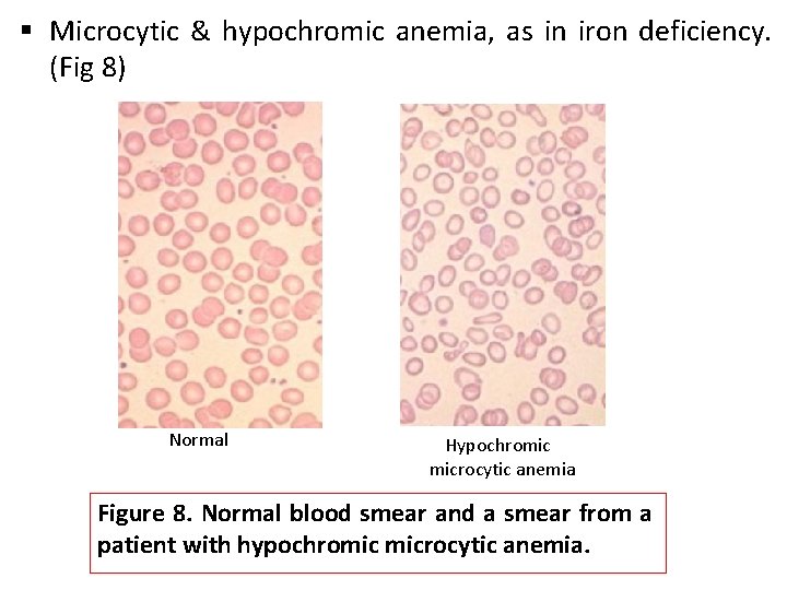 § Microcytic & hypochromic anemia, as in iron deficiency. (Fig 8) Normal Hypochromic microcytic