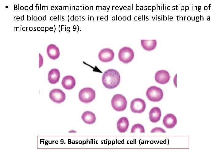 § Blood film examination may reveal basophilic stippling of red blood cells (dots in