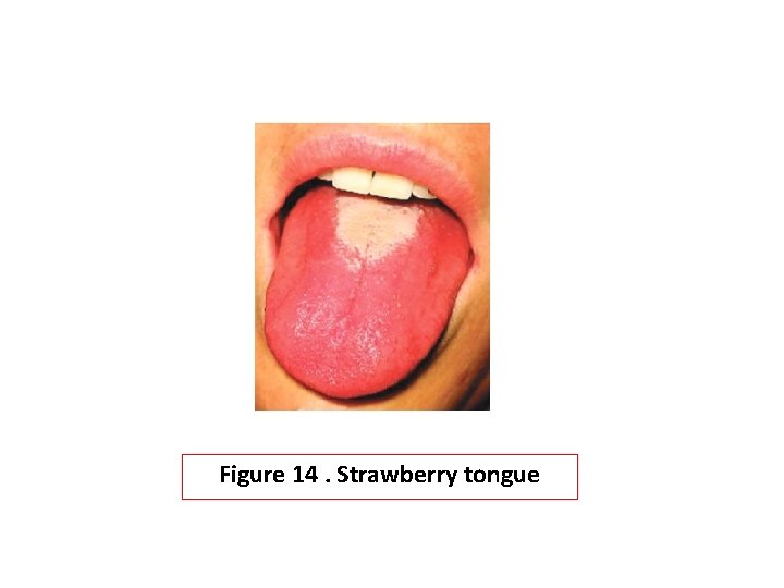 Figure 14. Strawberry tongue 