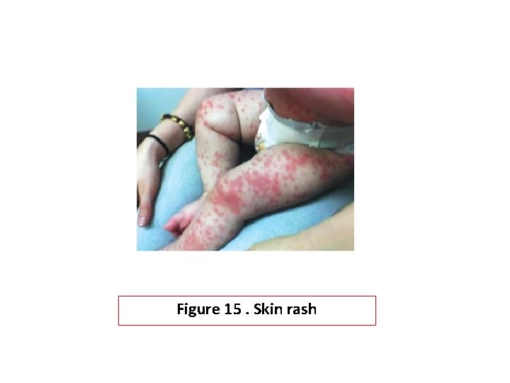 Figure 15. Skin rash 