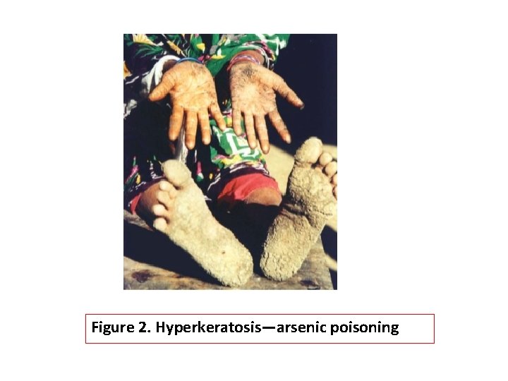 Figure 2. Hyperkeratosis—arsenic poisoning 