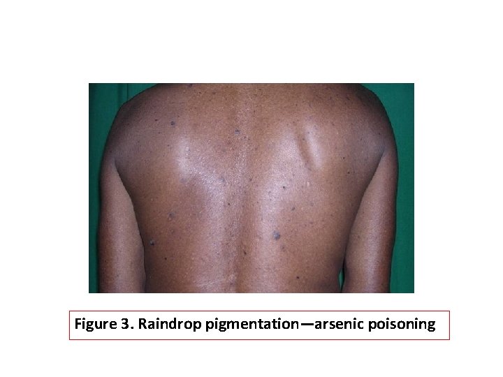 Figure 3. Raindrop pigmentation—arsenic poisoning 