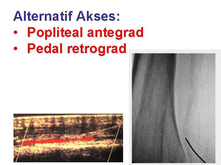 Alternatif Akses: • Popliteal antegrad • Pedal retrograd 