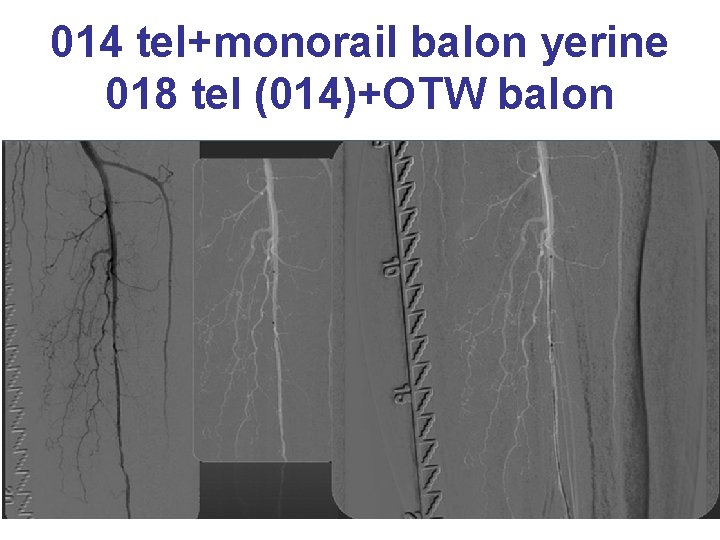 014 tel+monorail balon yerine 018 tel (014)+OTW balon 