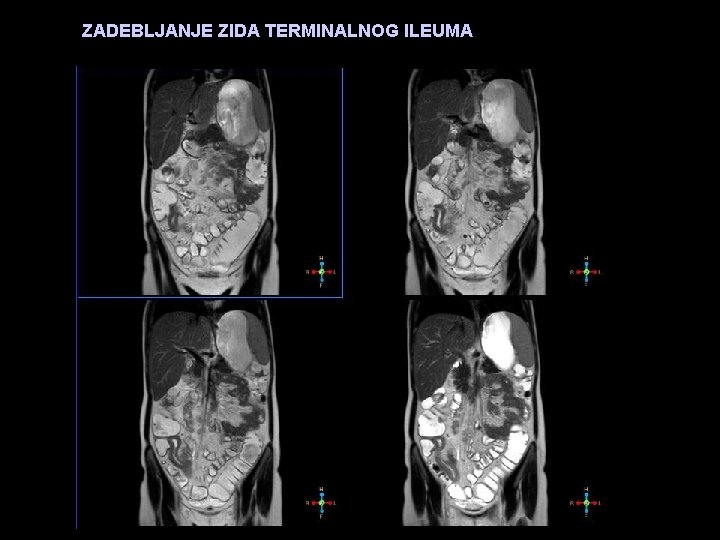 ZADEBLJANJE ZIDA TERMINALNOG ILEUMA ZADEBLJANJE ZIDA 