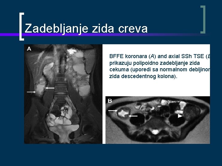 Zadebljanje zida creva BFFE koronara (A) and axial SSh TSE (B) prikazuju polipoidno zadebljanje