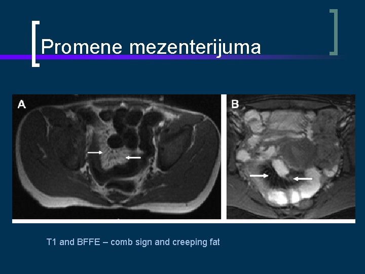 Promene mezenterijuma T 1 and BFFE – comb sign and creeping fat 