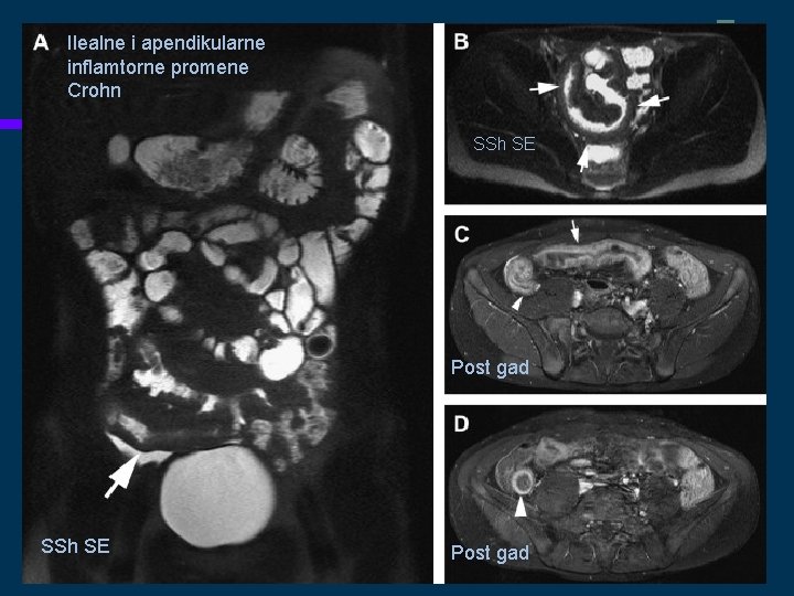 Ilealne i apendikularne inflamtorne promene Crohn SSh SE Post gad 