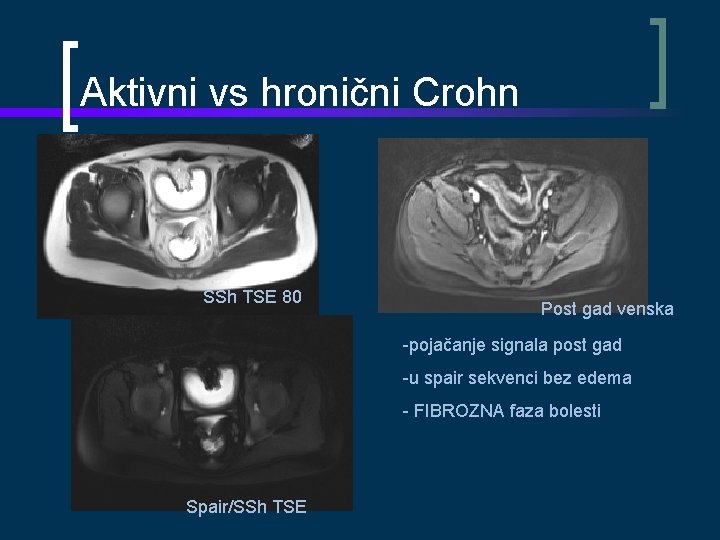 Aktivni vs hronični Crohn SSh TSE 80 Post gad venska -pojačanje signala post gad