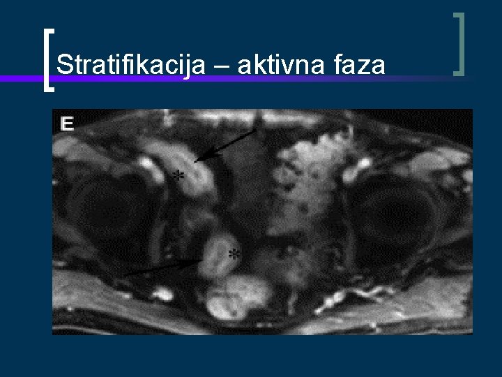 Stratifikacija – aktivna faza 