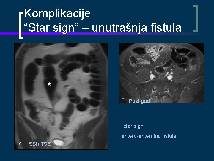 Komplikacije “Star sign” – unutrašnja fistula Post gad “star sign" entero-enteralna fistula SSh TSE