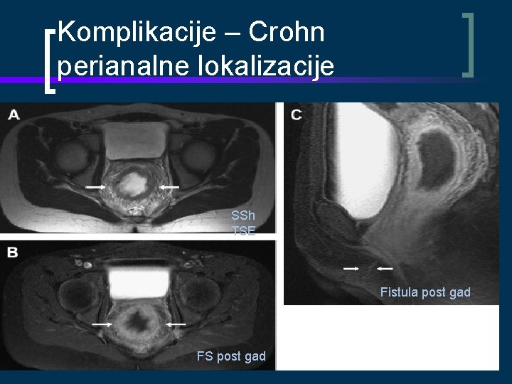 Komplikacije – Crohn perianalne lokalizacije SSh TSE Fistula post gad FS post gad 