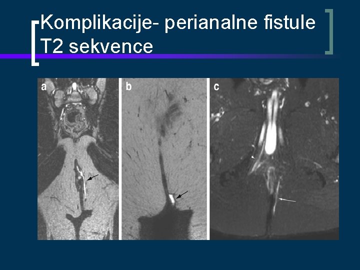 Komplikacije- perianalne fistule T 2 sekvence 