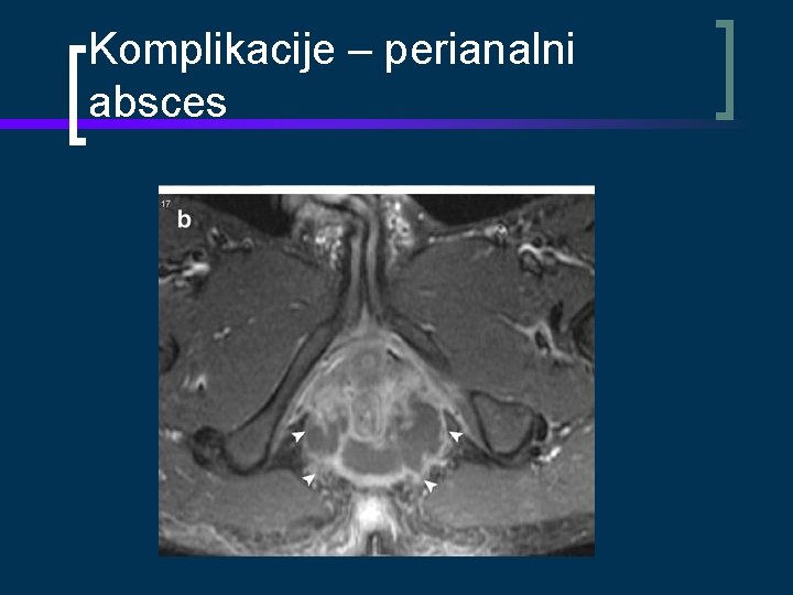 Komplikacije – perianalni absces 
