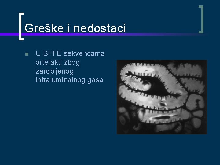 Greške i nedostaci U BFFE sekvencama artefakti zbog zarobljenog intraluminalnog gasa 