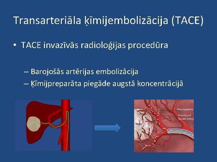 Transarteriāla ķīmijembolizācija (TACE) • TACE invazīvās radioloģijas procedūra – Barojošās artērijas embolizācija – Ķīmijpreparāta