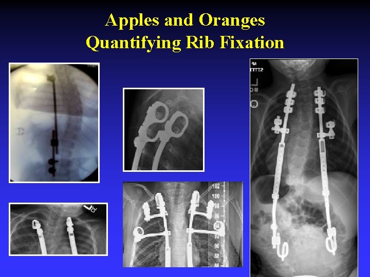 Apples and Oranges Quantifying Rib Fixation 