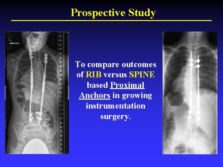 Prospective Study To compare outcomes of RIB versus SPINE based Proximal Anchors in growing