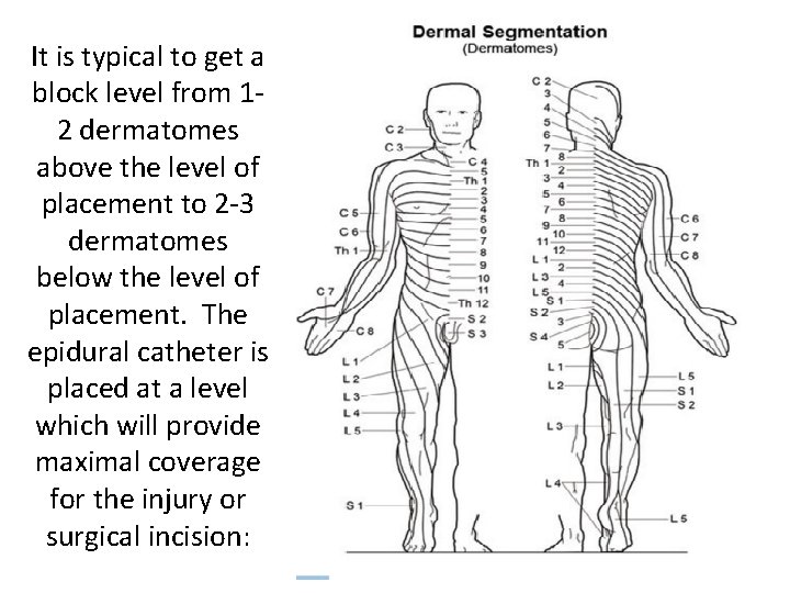 It is typical to get a block level from 12 dermatomes above the level