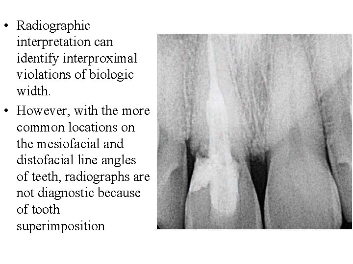  • Radiographic interpretation can identify interproximal violations of biologic width. • However, with