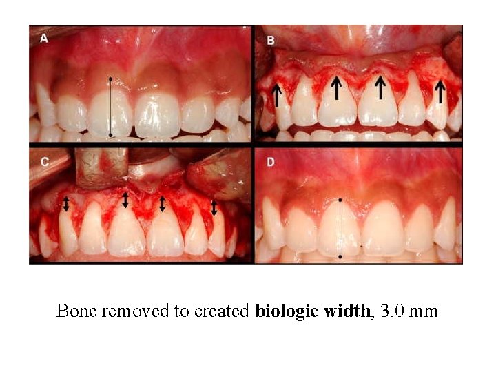 Bone removed to created biologic width, 3. 0 mm 