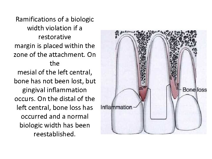 Ramifications of a biologic width violation if a restorative margin is placed within the