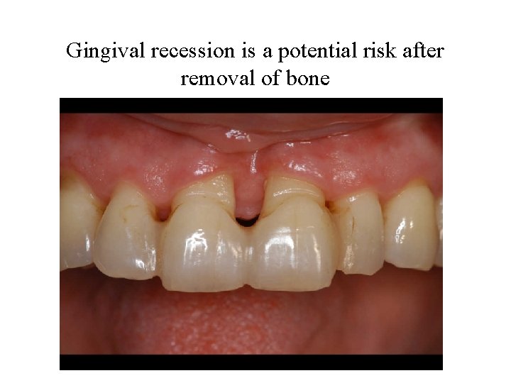 Gingival recession is a potential risk after removal of bone 