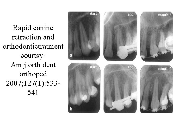 Rapid canine retraction and orthodontictratment courtsy. Am j orth dent orthoped 2007; 127(1): 533541