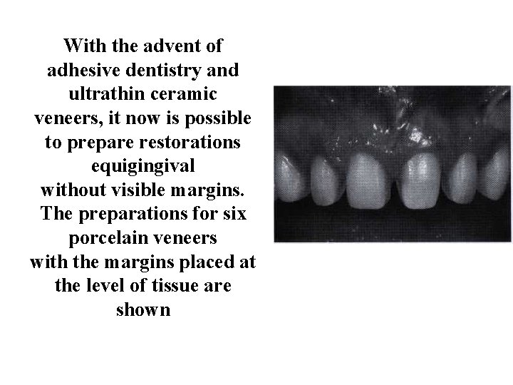 With the advent of adhesive dentistry and ultrathin ceramic veneers, it now is possible