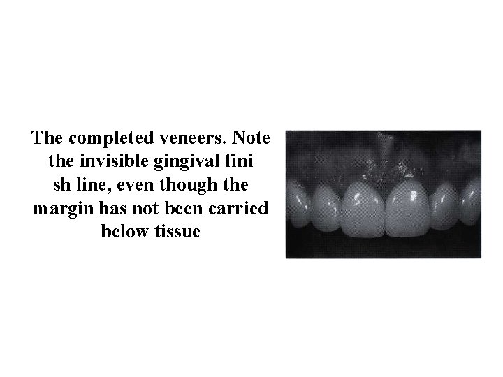 The completed veneers. Note the invisible gingival fini sh line, even though the margin